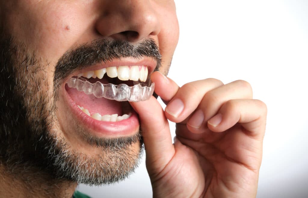 Adult with Invisalign® in Hendersonville inserting his clear aligner