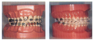 Full Braces