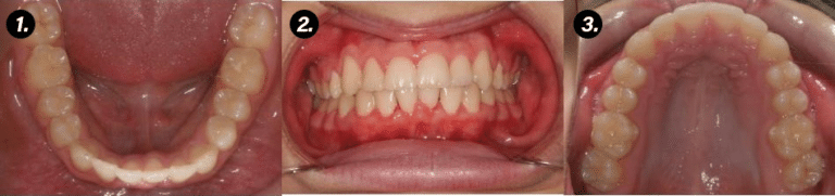 Photographs of a patient's bite from the front, top and bottom