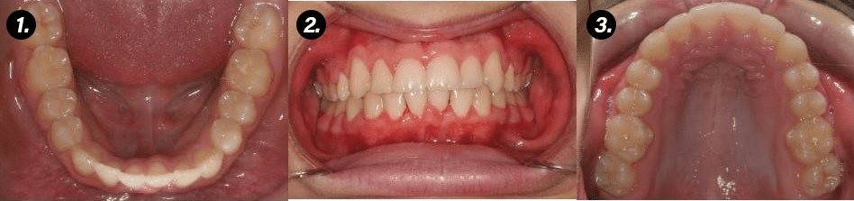 Three photos of teeth. One of the lower teeth, one of the upper teeth, and one of both.