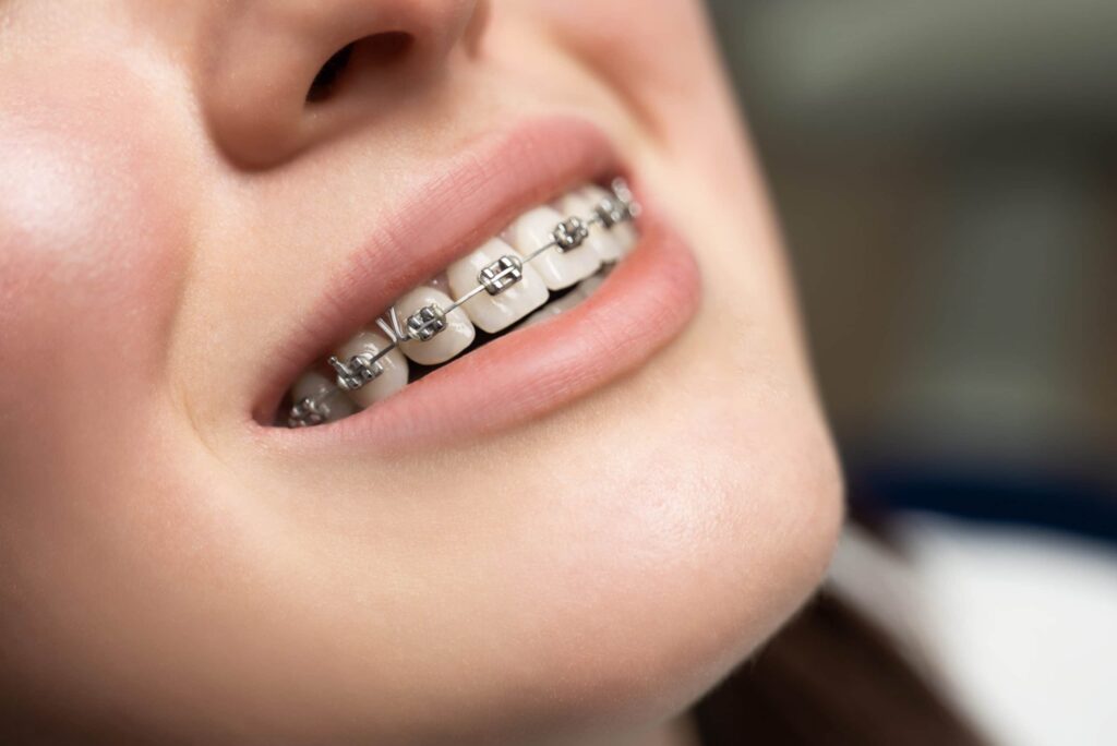 Close-up of the smile of young woman with traditional metal braces in Hendersonville, TN