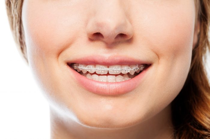 Close-up picture of happy woman's smile with orthodontic clear braces