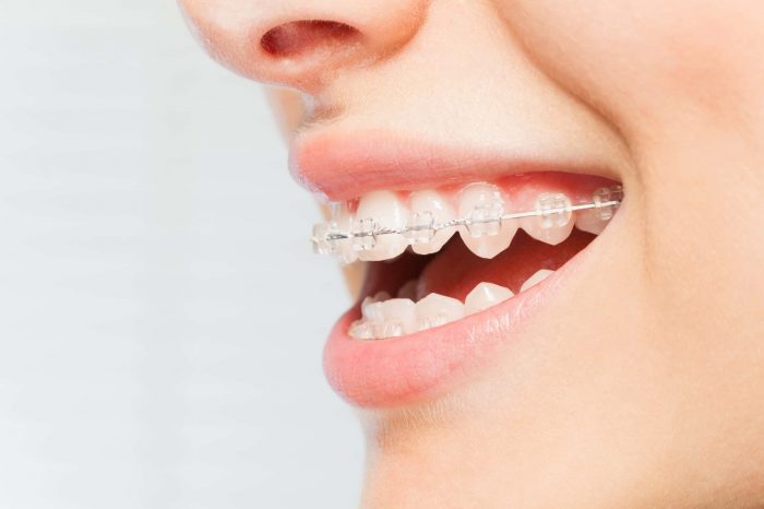 A close up profile of a girl with clear braces.