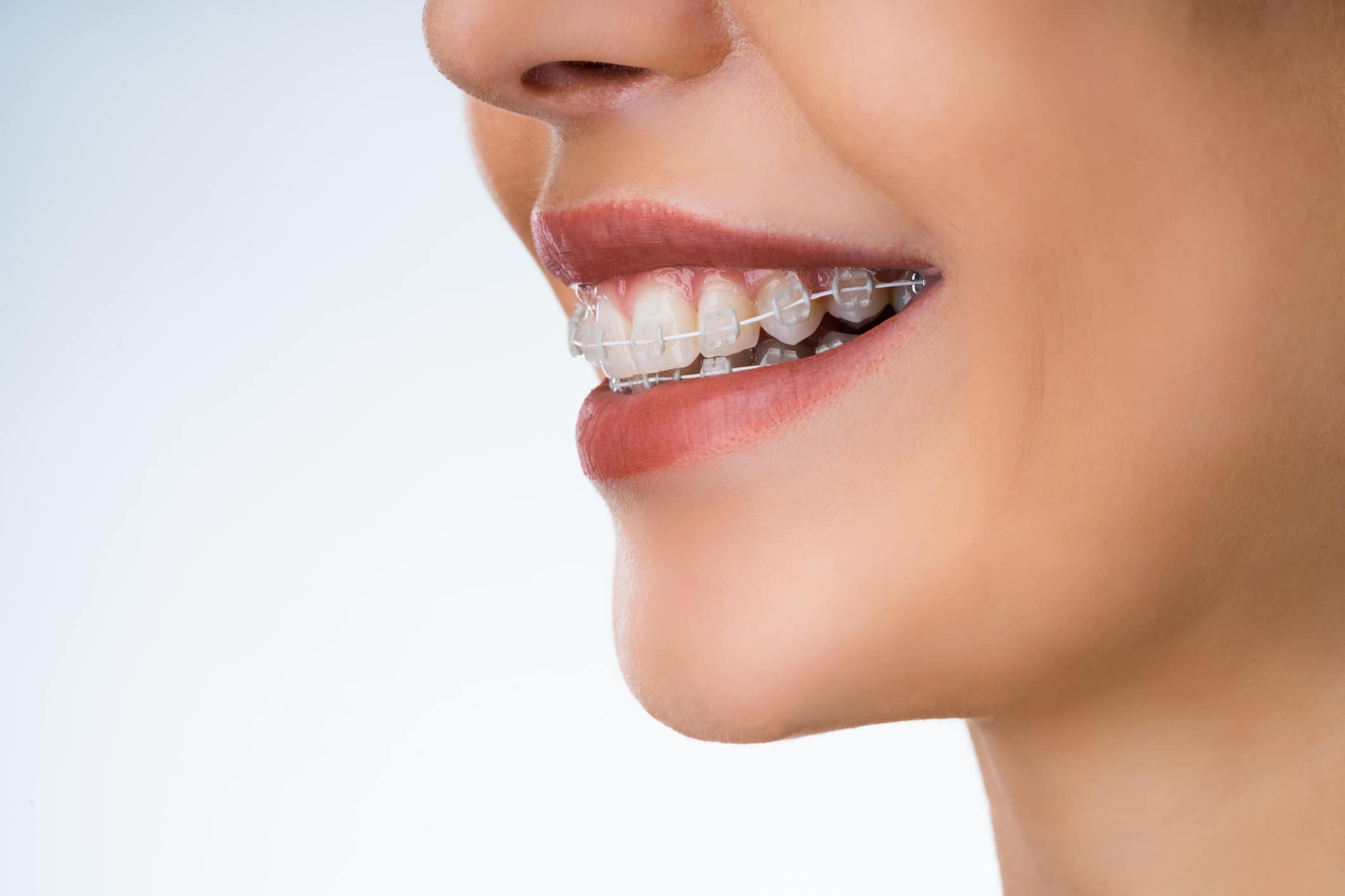 Close up of the smile of a woman with clear braces from the side