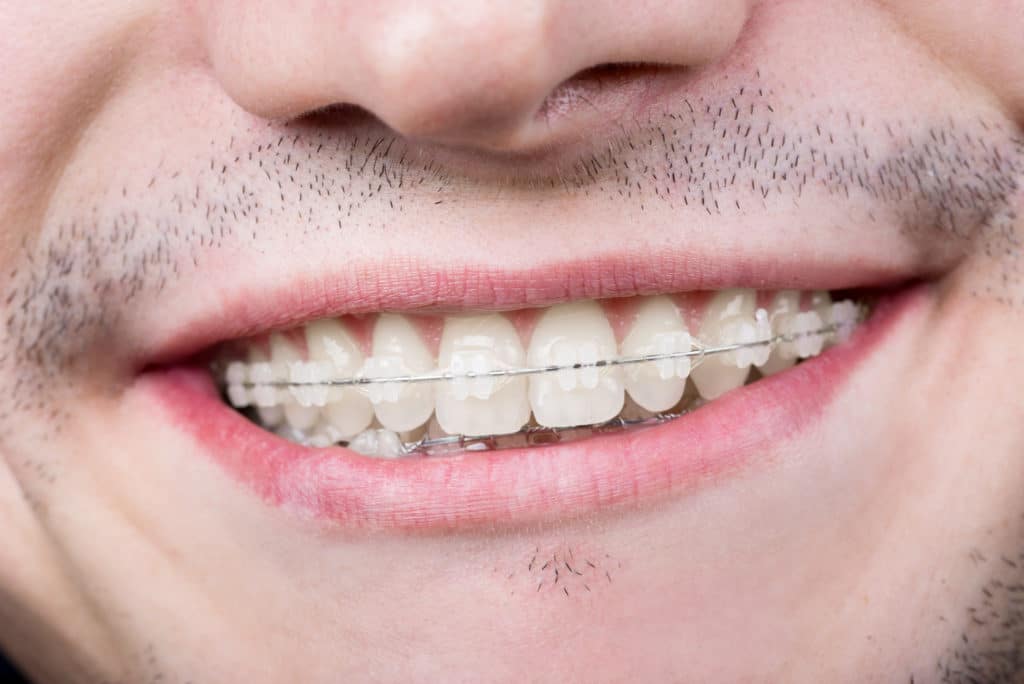 Close up of a man with stubble and clear braces.